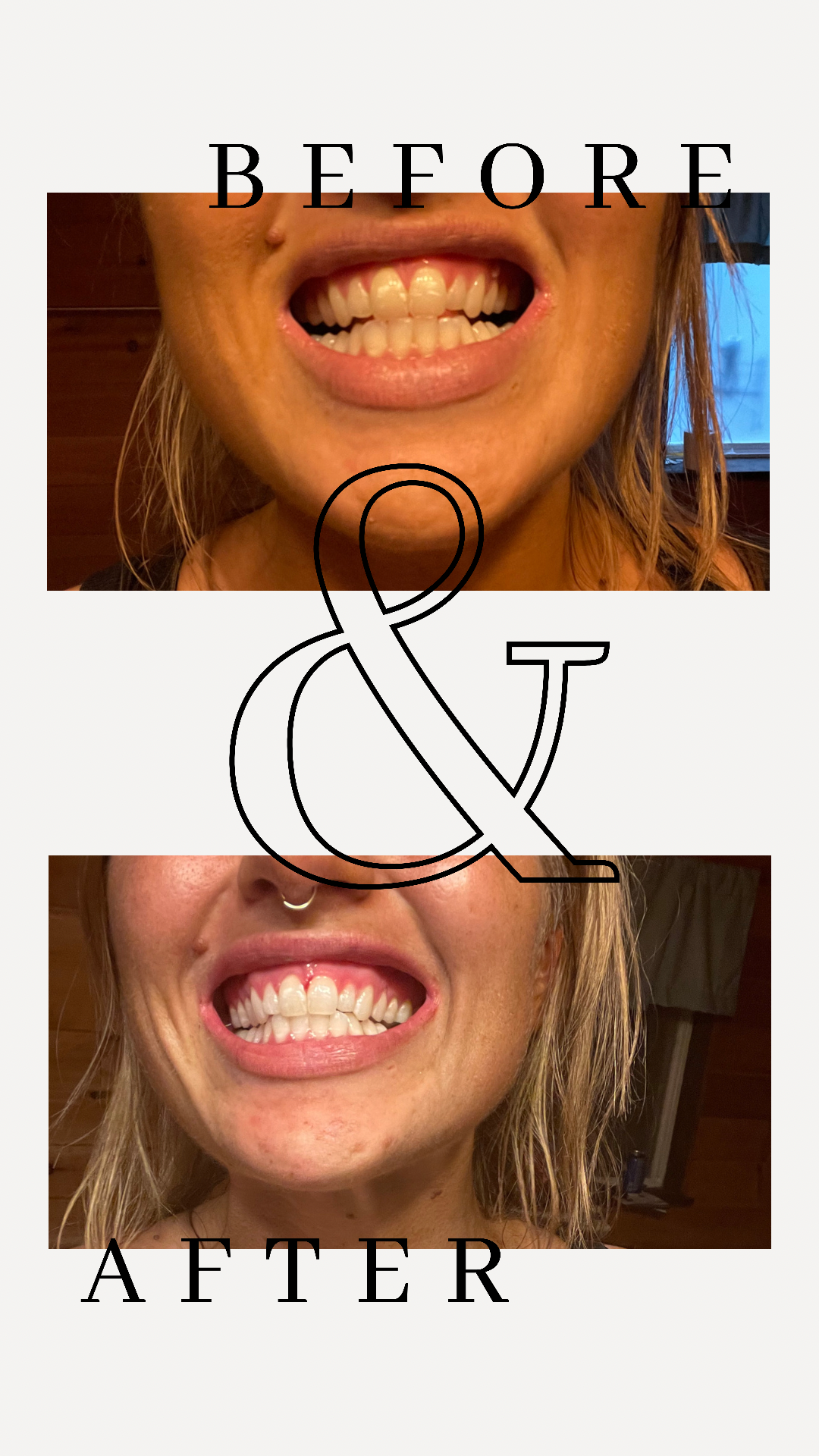 Teeth Whitening + Spray tan+ Remineralization Glowgetters Custom