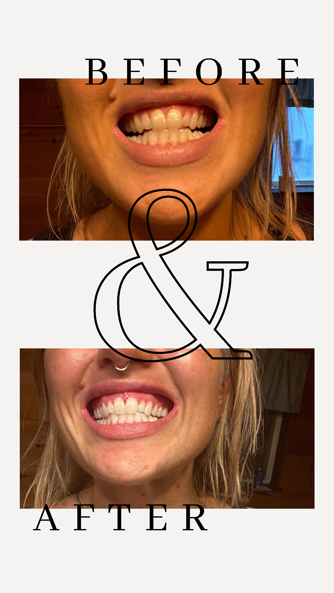 Teeth Whitening + Spray tan+ Remineralization